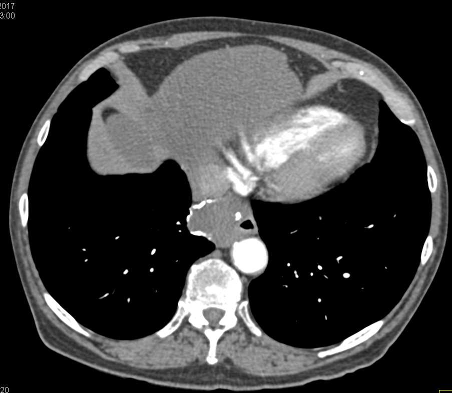 Leiomyoma Esophagus - CTisus CT Scan