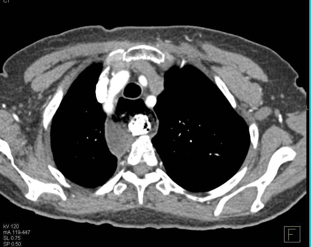 Dilated Esophagus with Retained Food and Contrast - CTisus CT Scan