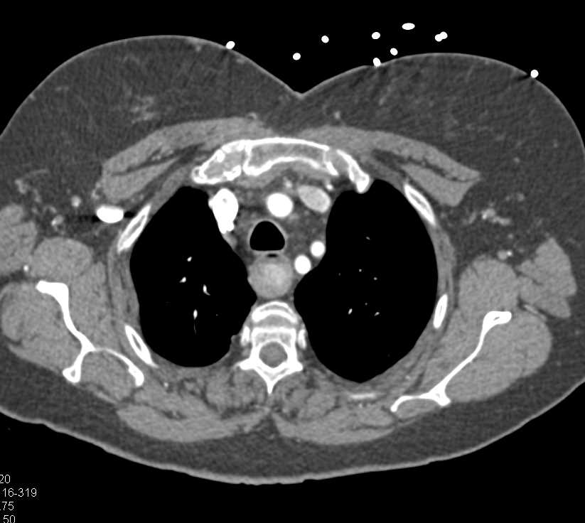 Active Bleed in the Lower Esophagus - CTisus CT Scan