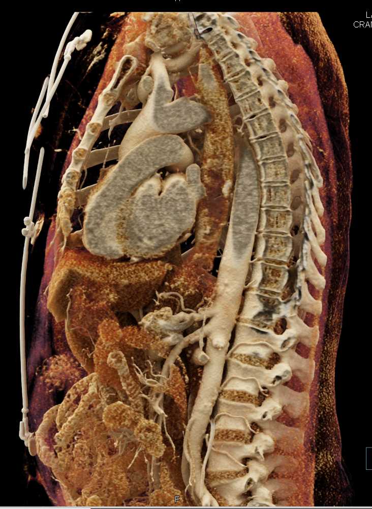 Active Bleed in the Lower Esophagus - CTisus CT Scan