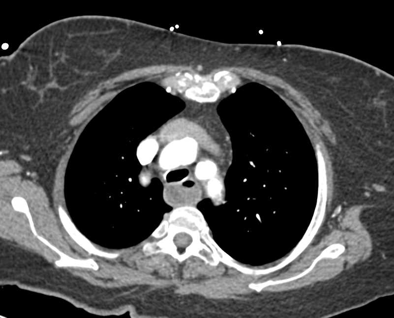 Dilated Esophagus with Tumor at EG Junction - CTisus CT Scan