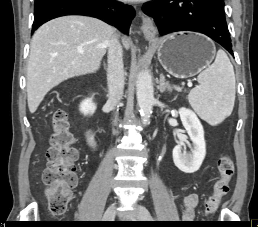 Hiatal Hernia - CTisus CT Scan