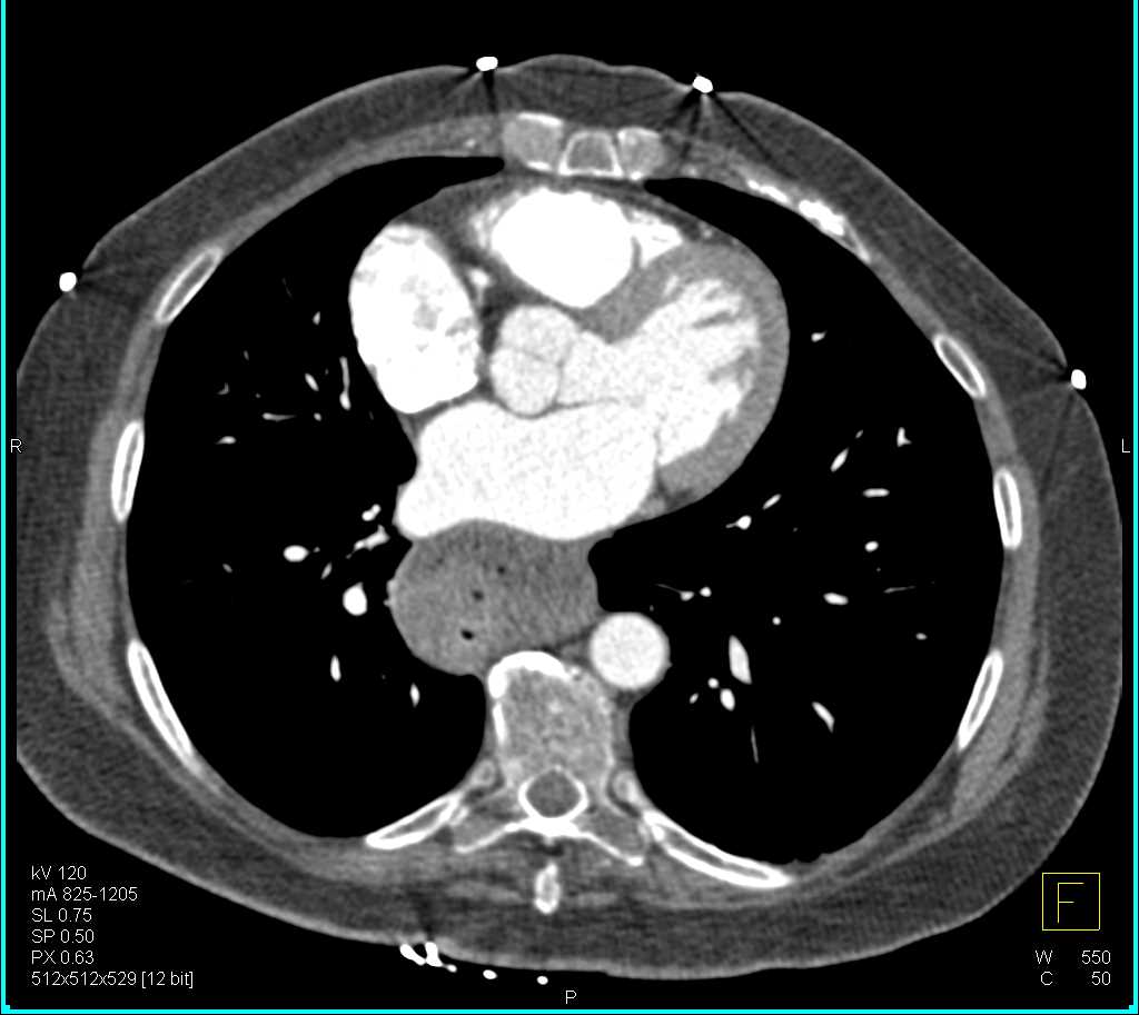 Achalasia - CTisus CT Scan