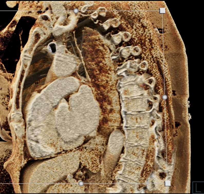 Achalasia - CTisus CT Scan