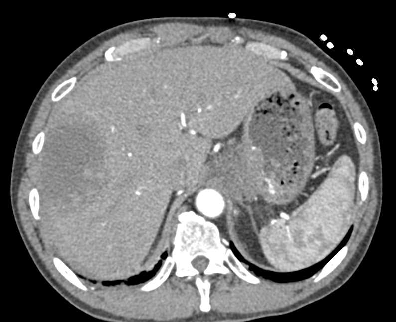 Carcinoma Gastroesophageal (GE) Junction with Metastases - CTisus CT Scan