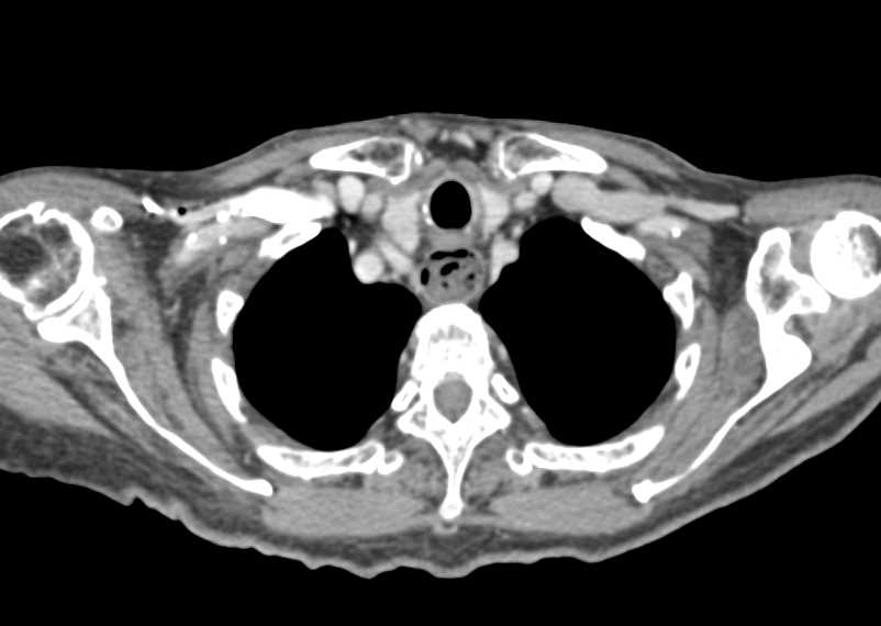 Esophageal Diverticulum - CTisus CT Scan