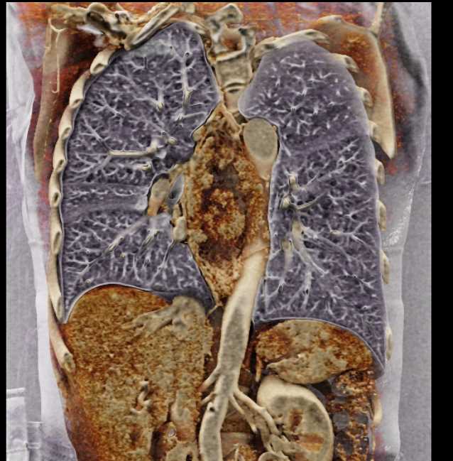 Squamous Cell Carcinoma of the Esophagus with Cinematic Rendering - CTisus CT Scan