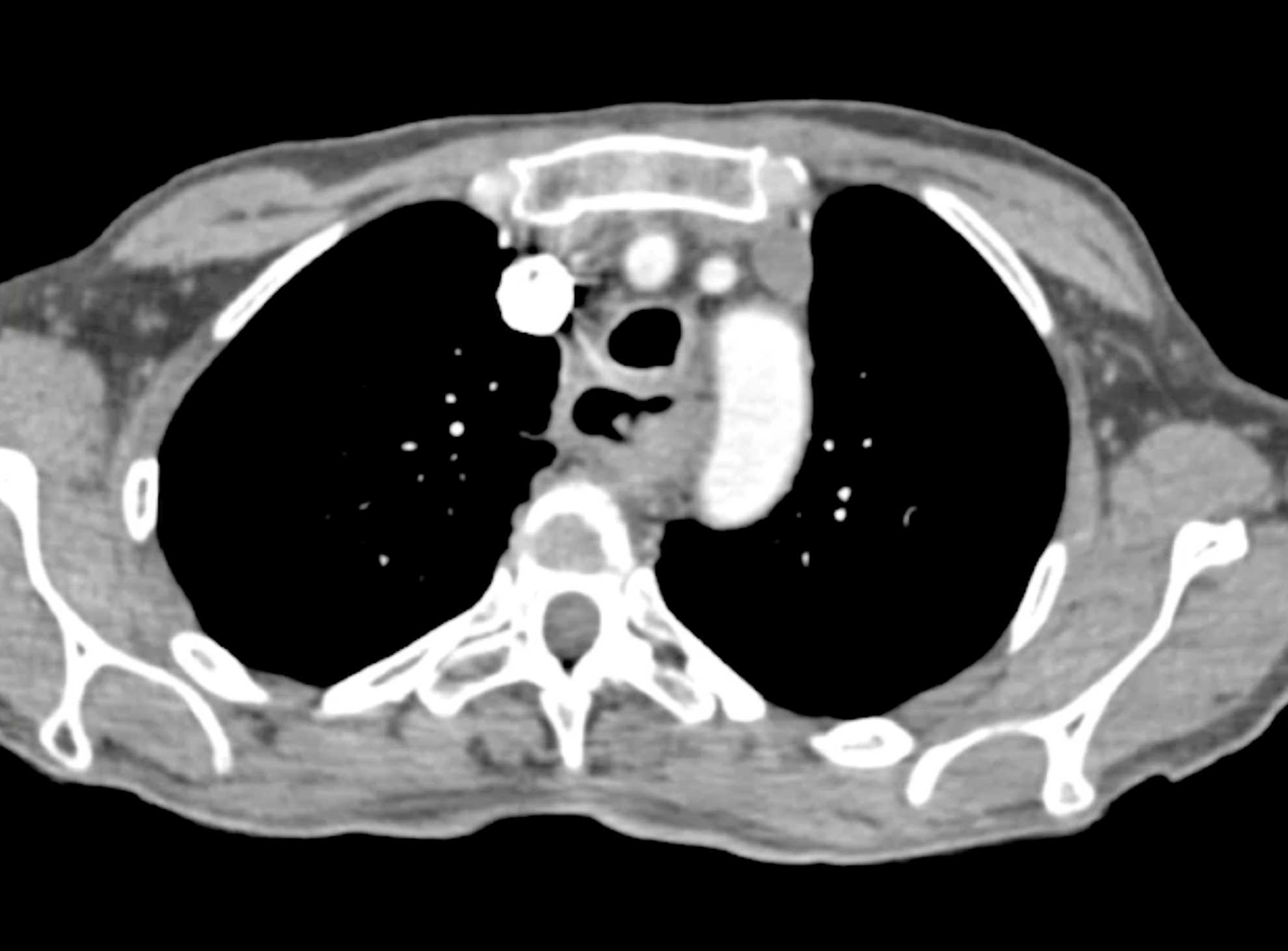 Esophageal Squamous Cancer with TE Fistulae - CTisus CT Scan