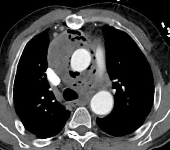 Aortoesphageal Fistula - CTisus CT Scan