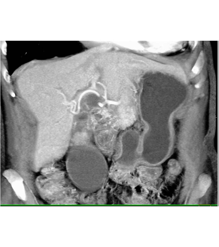 Gallbladder Cancer - CTisus CT Scan