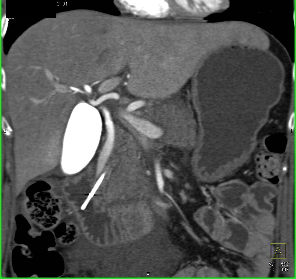 3D Visualization of Gallbladder, Cystic Duct and Common Bile Duct - CTisus CT Scan