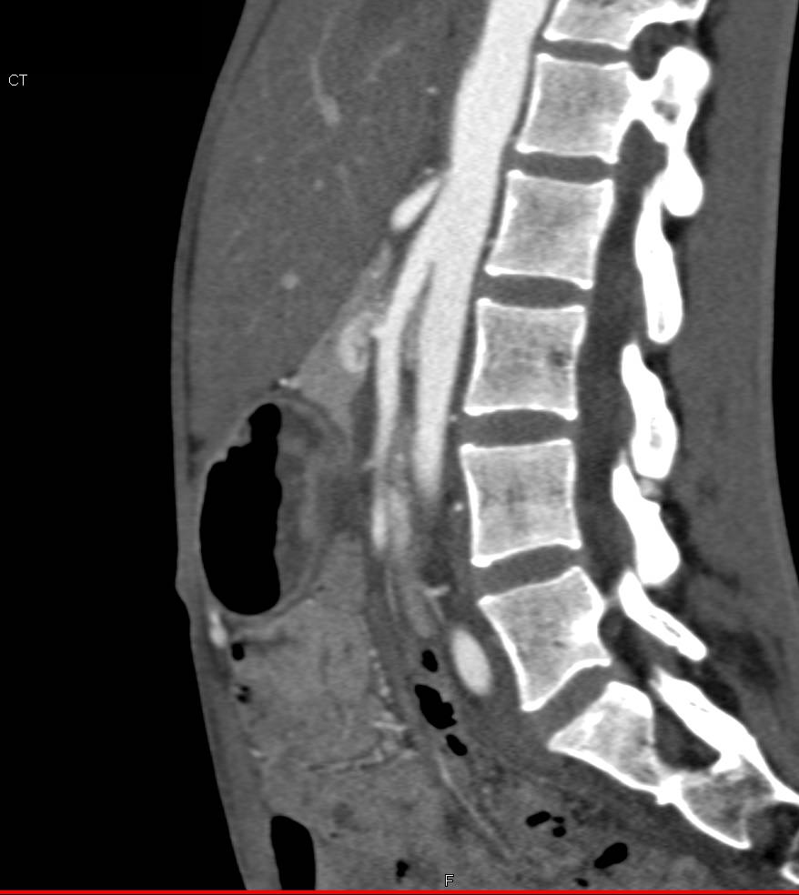 Superior Mesenteric Artery (SMA) Syndrome with Dilated Left Gonadal Vein - CTisus CT Scan