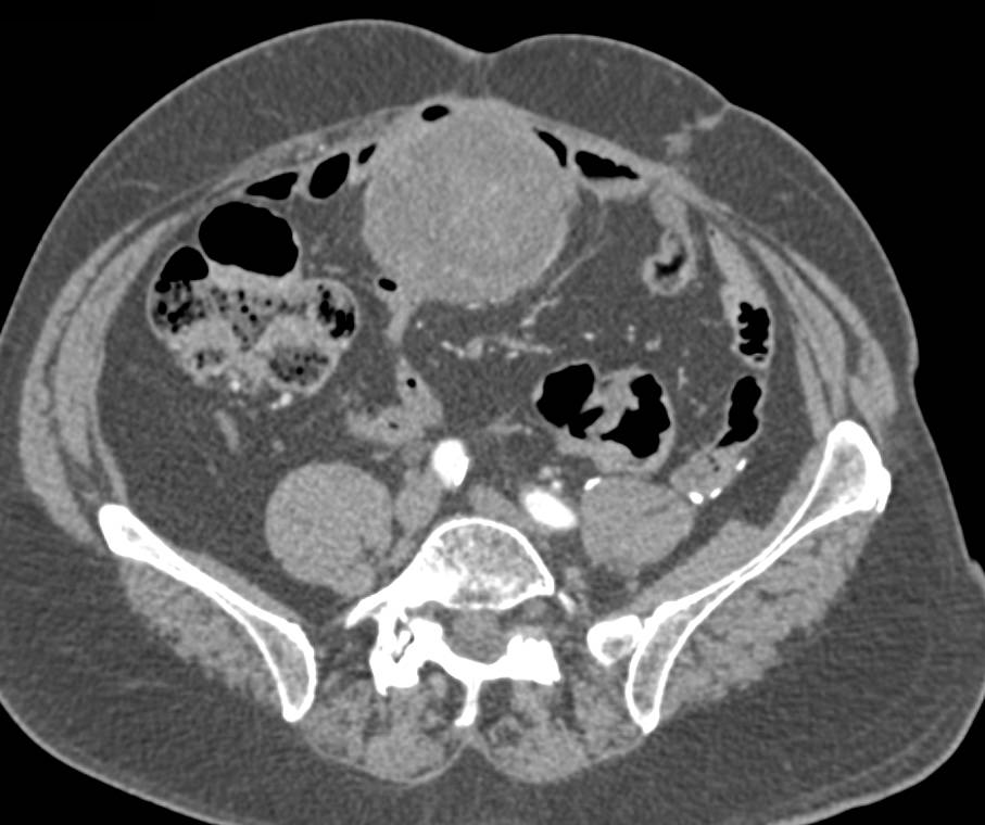 Abscess near level of Umbilicus - CTisus CT Scan