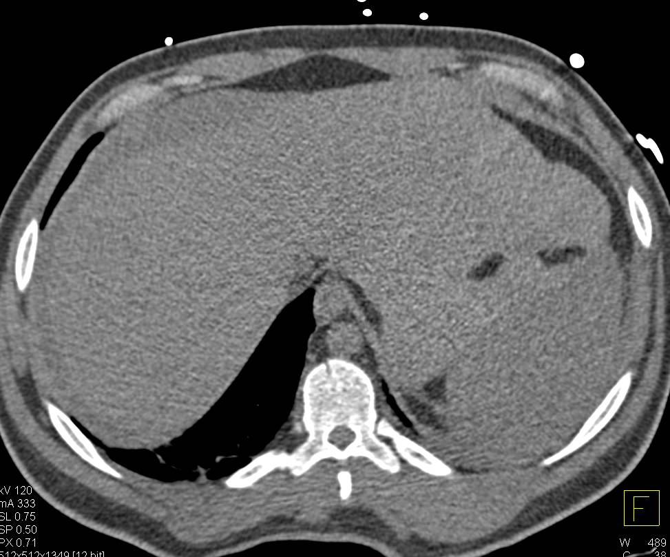 Hemoperitoneum Seen on Non-contrast CT - CTisus CT Scan