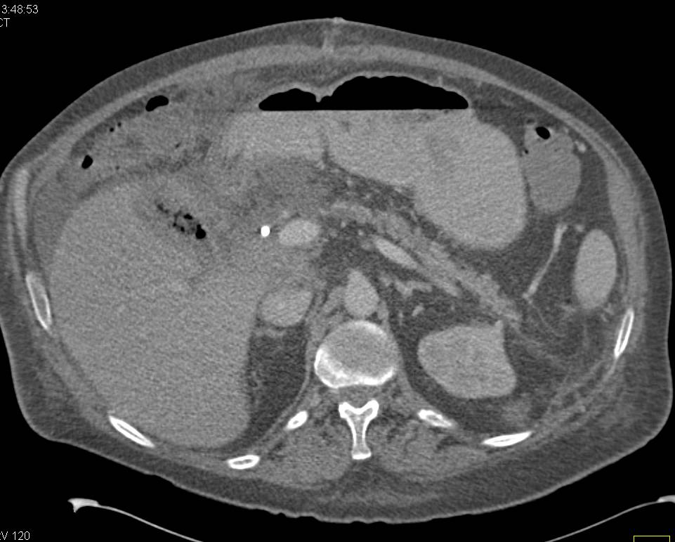 Emphysematous Cholecystitis - CTisus CT Scan
