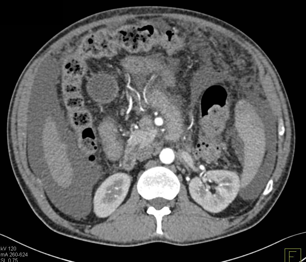 Carcinomatosis with Omental Implants - CTisus CT Scan