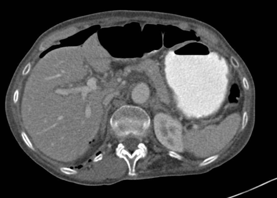 Pneumoperitoneum due to Perforated Gastric Ulcer - CTisus CT Scan