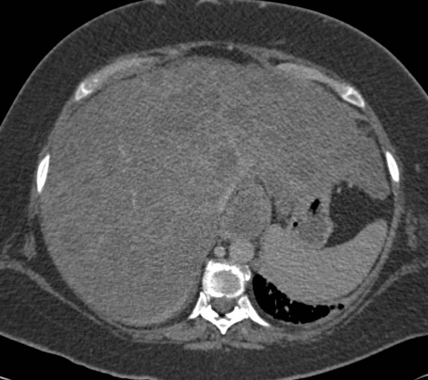 Fatty Liver with Liver Metastases - CTisus CT Scan