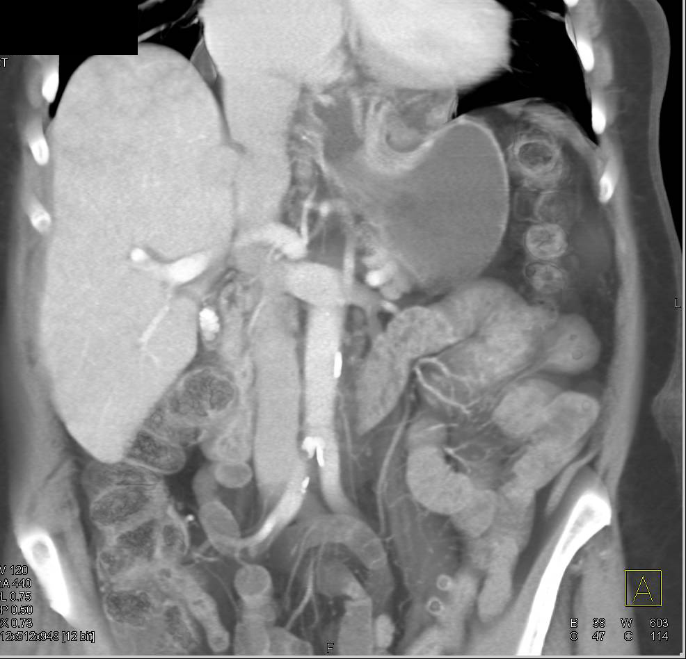 Large Hiatal Hernia - CTisus CT Scan
