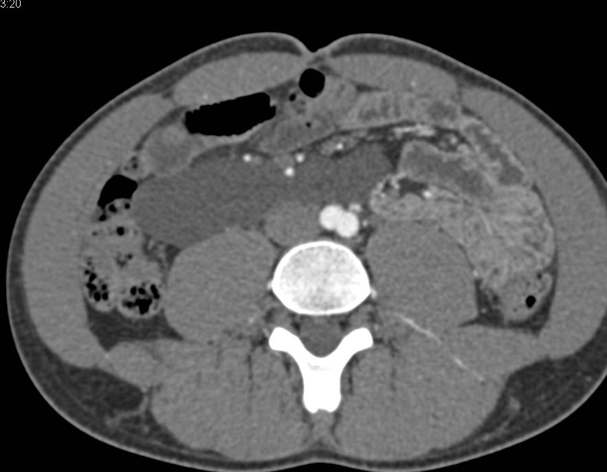 Lymphangioma in the Root of the Mesentery - CTisus CT Scan