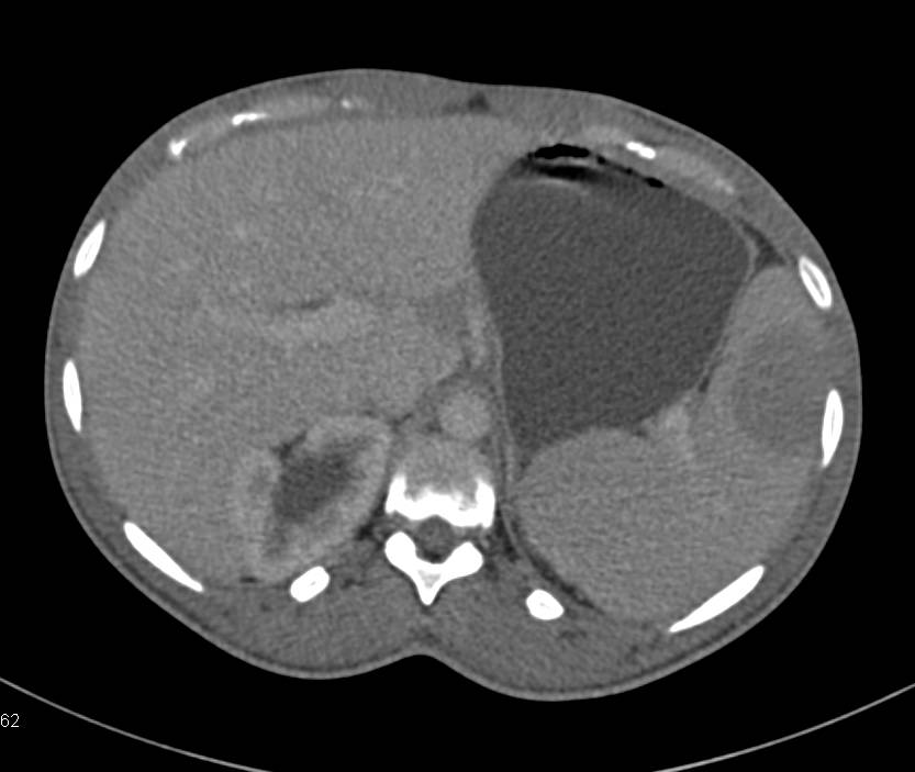 Retroperitoneal Sarcoma with Splenic Involvement - CTisus CT Scan