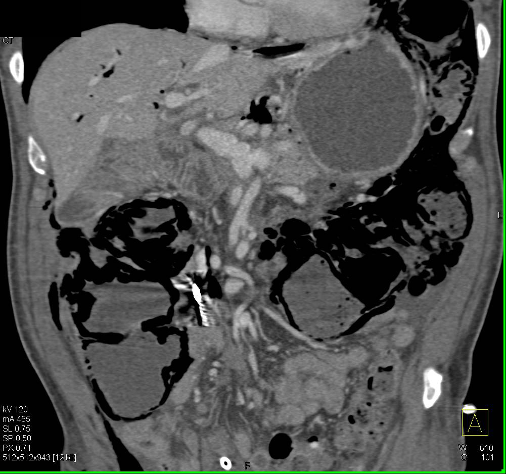 Pneumoperitoneum and Pneumatosis Coli Following G-Tube Placement - CTisus CT Scan