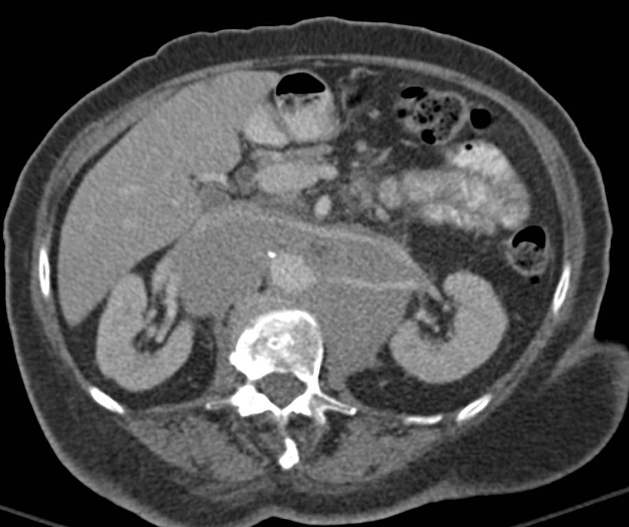Lymphoma with Extensive Para-aortic Adenopathy and Mesenteric Mass - CTisus CT Scan