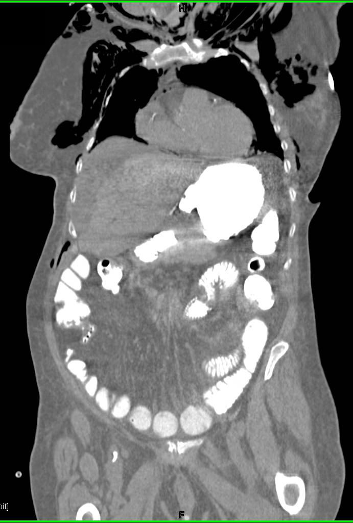 Pneumoperitoneum Following G-Tube Placement Attempt - CTisus CT Scan