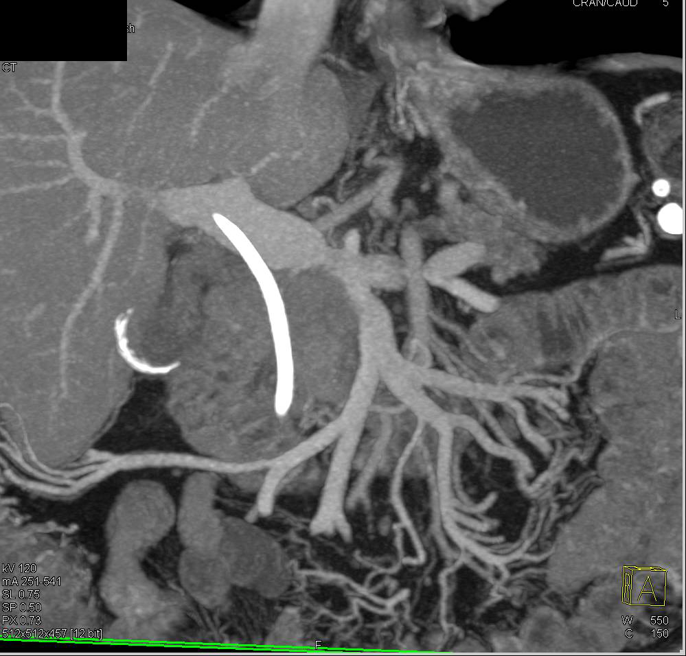 Gallbladder Cancer with Adenopathy - CTisus CT Scan