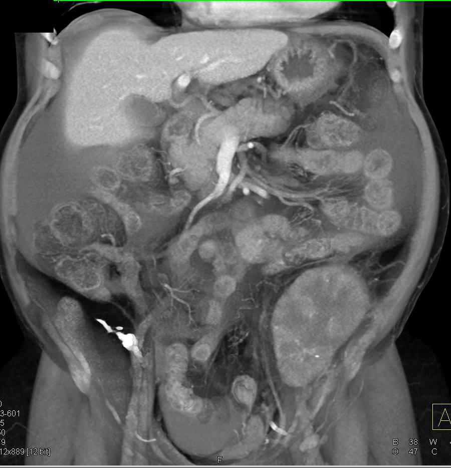 Peritoneal Carcinomatosis and Failed Renal Transplant - CTisus CT Scan