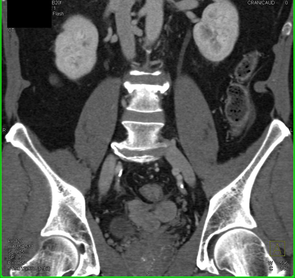 Pelvic Tumor Implants - CTisus CT Scan