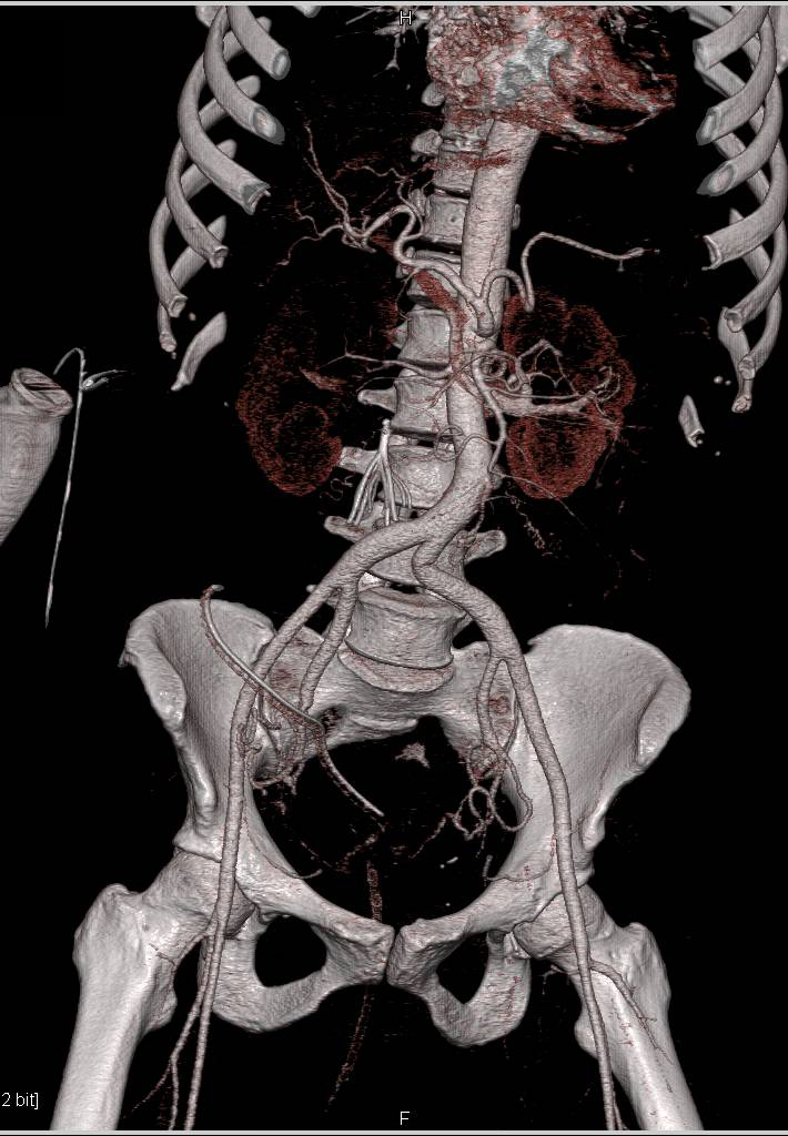Intra-abdominal Abscess - CTisus CT Scan