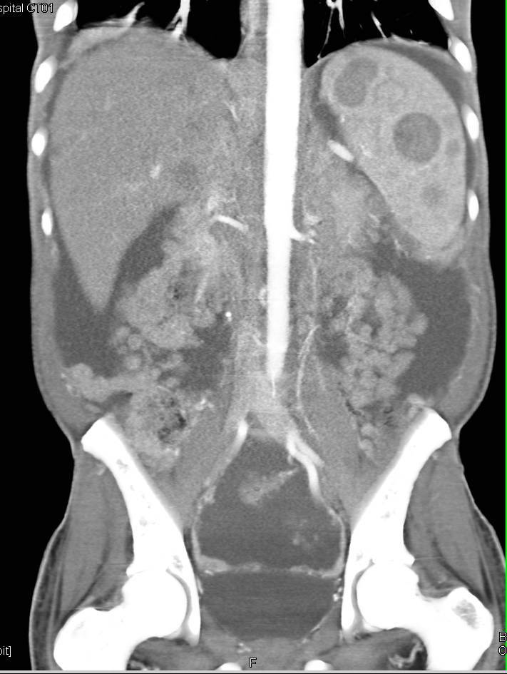 Carcinomatosis with Splenic and Liver Metastasis due to Metastatic Melanoma - CTisus CT Scan