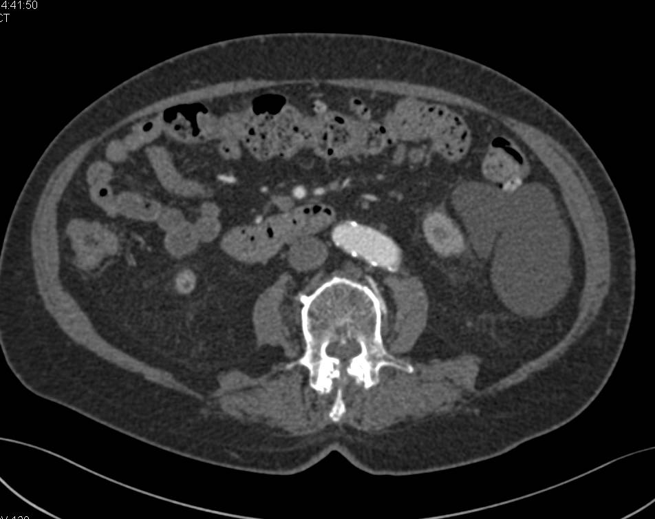 Cystic Lymphangioma - CTisus CT Scan