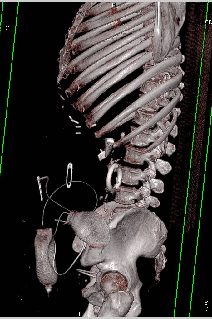 Retained Sponge in Left Upper Quadrant - CTisus CT Scan