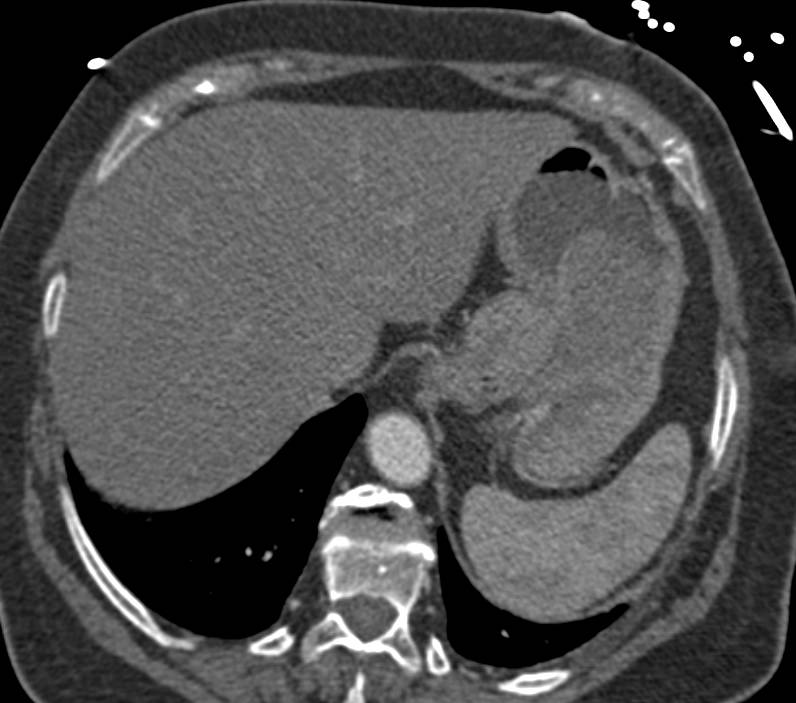 Bulky Gastric Adenocarcinoma in the Fundus Looks Like a GIST - CTisus CT Scan