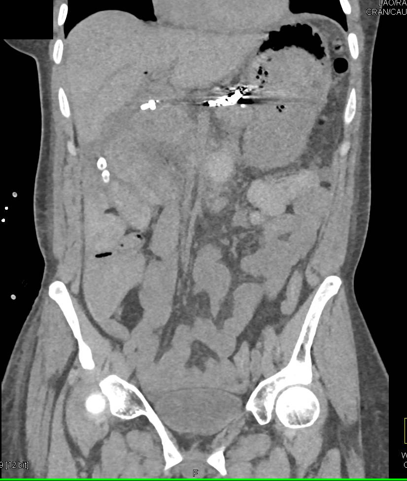 Post Whipple Procedure with Drains in Place and Fluid Present - CTisus CT Scan