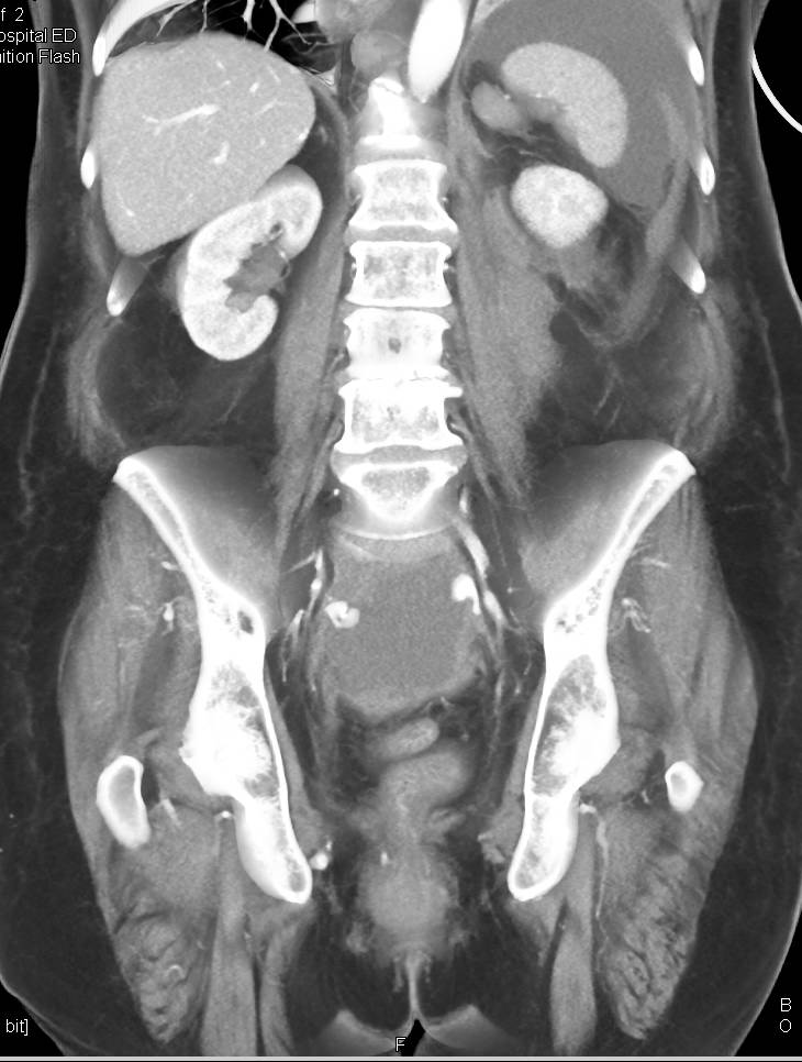 Active Bleed in Left Psoas Muscle and in the Left Upper Quadrant and Pelvis - CTisus CT Scan