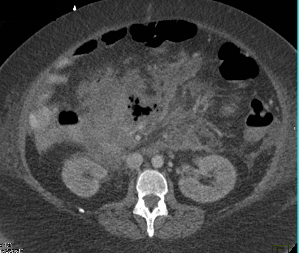 Pancreatic Necrosis with Pancreatic Abscess - CTisus CT Scan