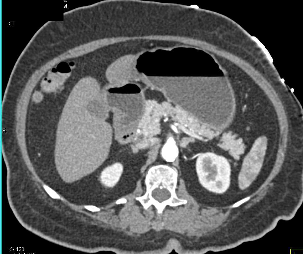 Active Bleed Left Colon due to Diverticulitis Best Seen on Venous Phase - CTisus CT Scan