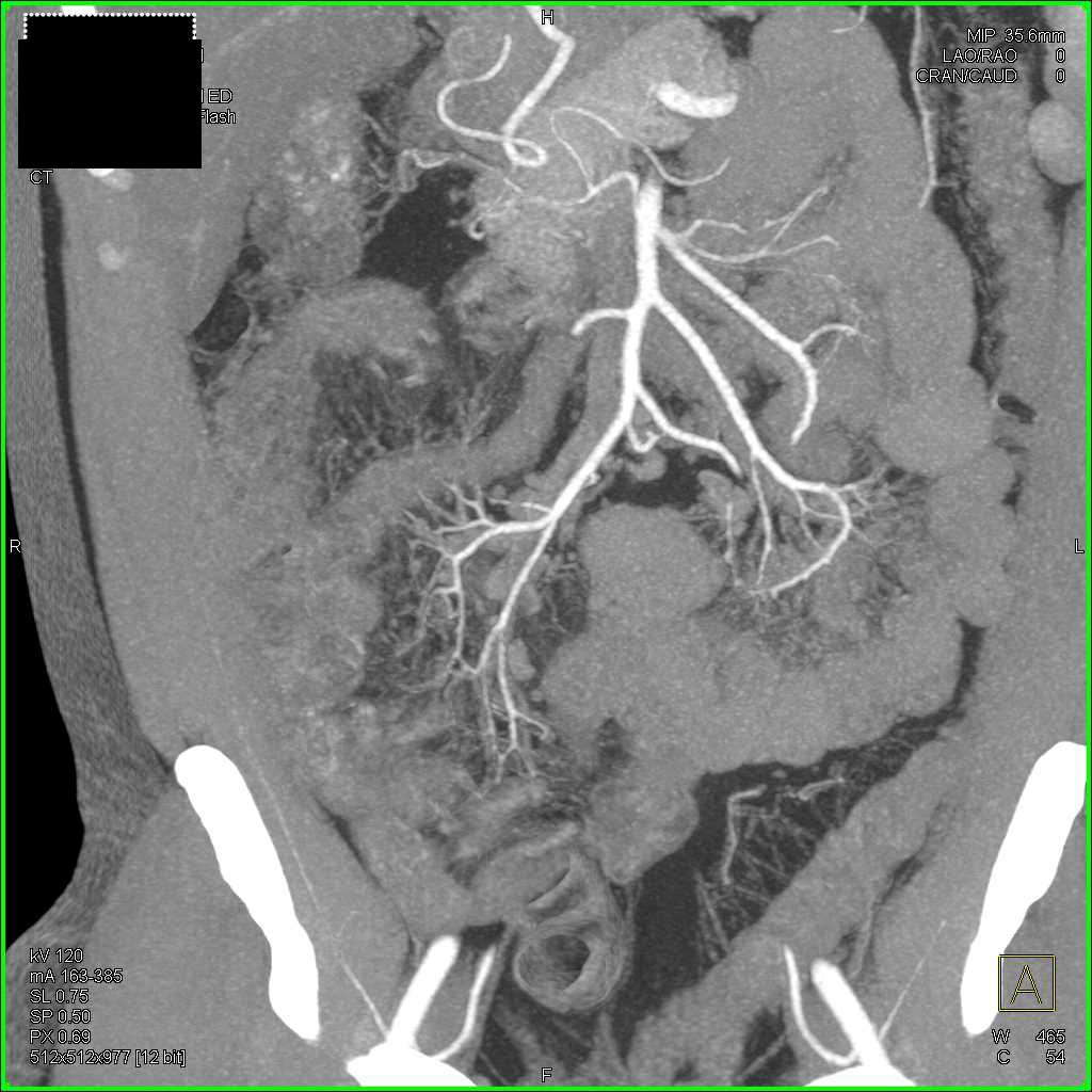 Crohn's Disease with Prominent Vasa Recta and Comb Sign - CTisus CT Scan