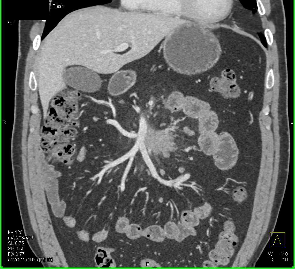 Carcinoid Tumor in the Root of the Mesentery Encases the SMA - CTisus CT Scan