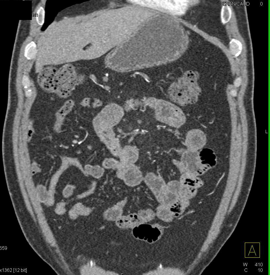 Carcinoid Tumor in the Root of the Mesentery Encases the SMA - CTisus CT Scan