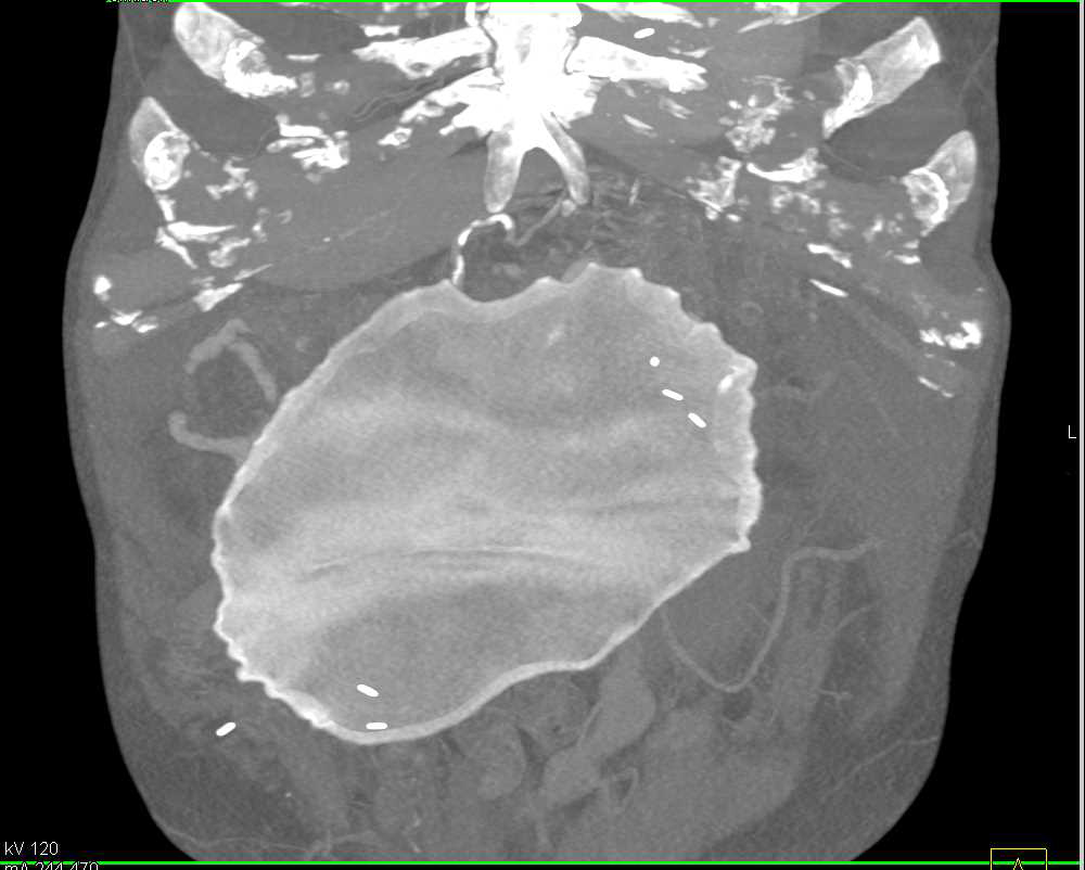 Mesh from Hernia Repair in Abdominal Wall - CTisus CT Scan