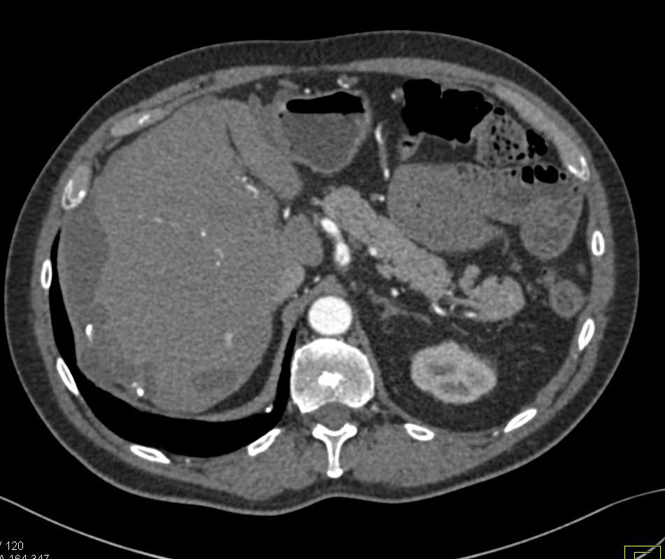 Pseudomyxoma Peritonei (PMP) with Liver Implants - CTisus CT Scan