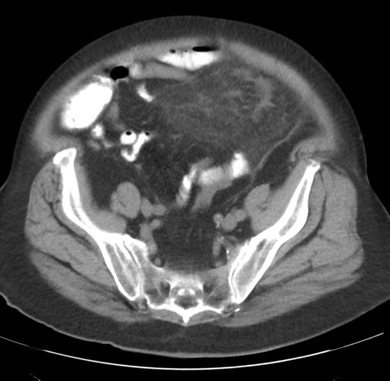 Inflammation of Mesenteric Fat - CTisus CT Scan