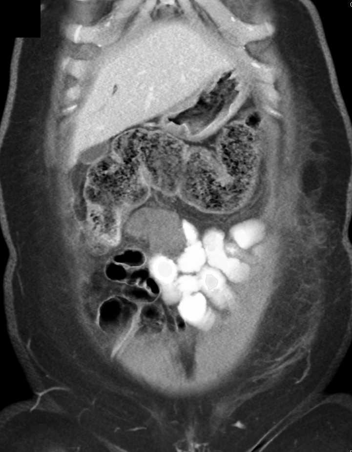 Mesenteric Cyst - CTisus CT Scan