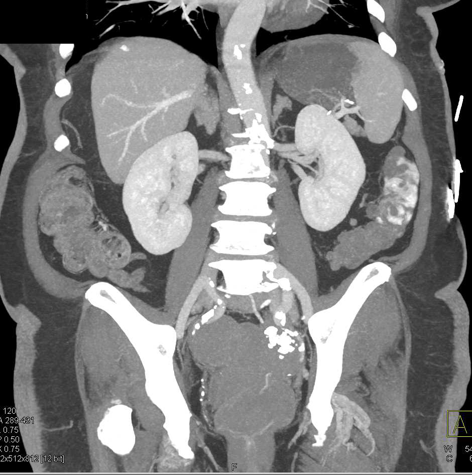 Active Bleed Descending Colon due to Diverticulitis - CTisus CT Scan
