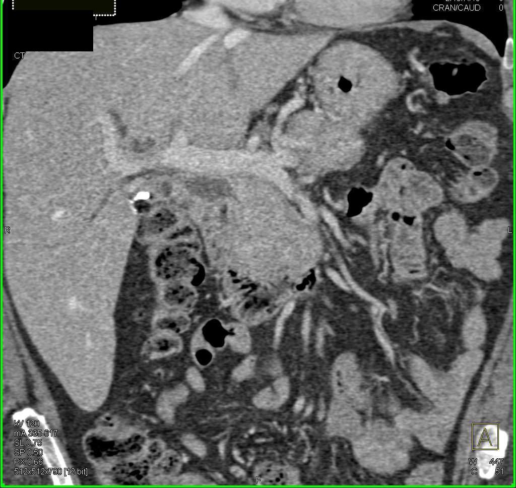Autoimmune Pancreatitis - CTisus CT Scan