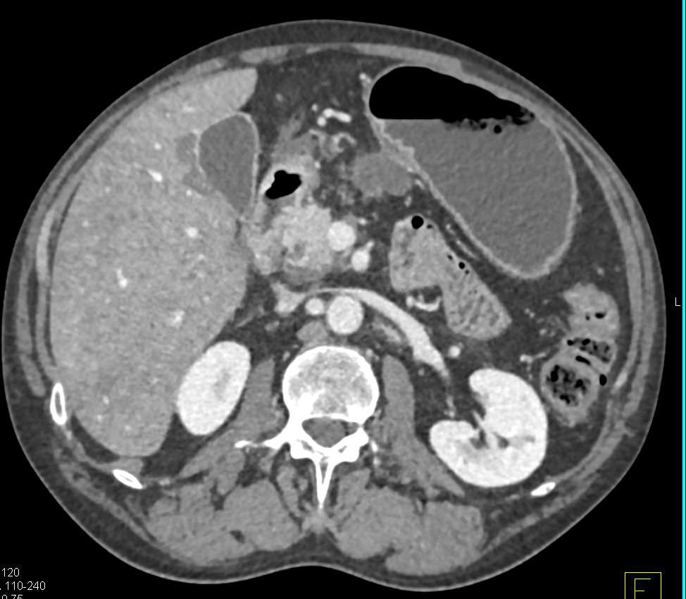 Carcinoma of the Gastric Antrum - CTisus CT Scan